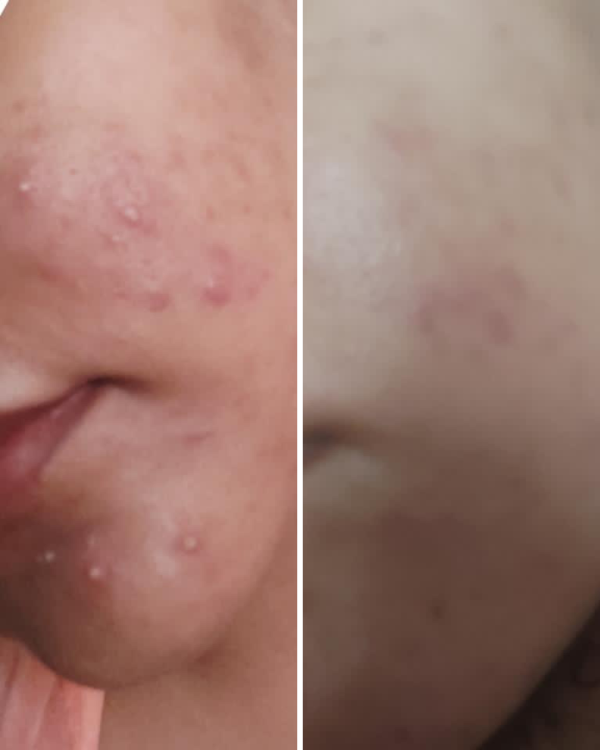 Anti Acne & Glowing Serum Vitamin C + E Serum – 15ml